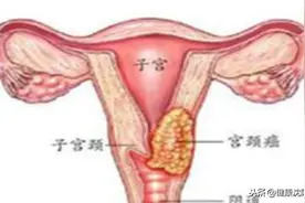 健康科普堂 | 小宫颈，大世界图片