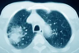 56岁肺癌患者，全身有红疹、水疱，疼痛不能忍受，该怎么办？图片
