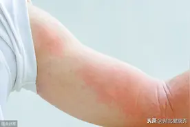 荨麻疹的9大诱因图片