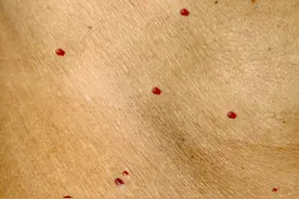 身上突然长了很多小红痣是什么原因？警惕：这两种痣图片