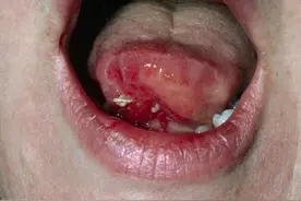 口腔溃疡没在意，结果2/3舌头被切掉！医生：这种零食别再吃了图片