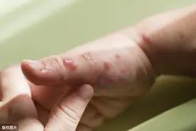 手上长小水泡，很痒，医生告诉你这不是湿疹，答案你可能想不到图片