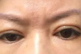 南昌：女子花18000元“禾丽医美”整形失败，院方也看了哑口无言图片