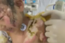 惨绝人寰！烫水浇头火烧嘴，6岁女童遭亲妈及其男友虐待险丧命图片