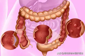 嘴唇、脸上、指尖长黑斑说明什么？不要轻视！警惕黑斑息肉病图片