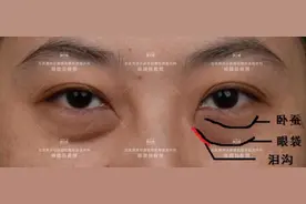 眼袋和泪沟凹陷同时存在怎么办？图片