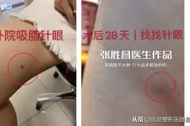你真的是疤痕体质吗？疤痕体质是整形绝缘体？吸脂真会明显留疤？图片