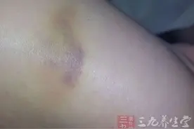 身体经常出现这些淤青，提高警惕图片