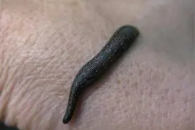 男子鼻腔取出蚂蝗 鼻腔异物应如何处理图片