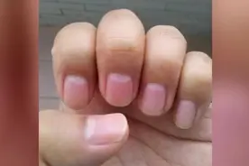 指甲上没月牙是病吗？吃一种食物7天长出月牙视频封面