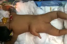 印度女婴出生时后背竟多出一条“腿”图片