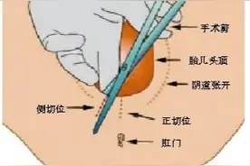 第71课：助产的方法图片
