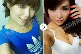 自体脂肪丰胸PK假体丰胸，看看你适合哪种？图片