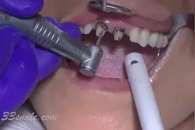烤瓷牙变这样必须拆掉，否则真牙都烂完了！