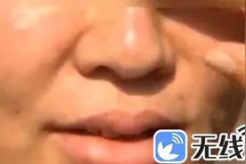 济南一女子美容面部不适起“硬包” 担心毁容想中止图片