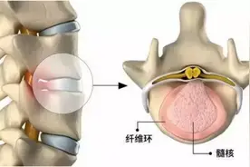 腰椎间盘突出难治？不妨使用曲度腰椎治疗仪从矫正变形腰椎开始图片