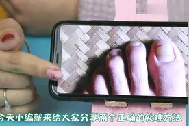 脚趾甲往肉里长！一碰就疼，教你个好方法不用找医生在家就能根治视频封面