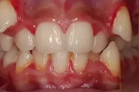 小虎牙矫正过程~视频封面