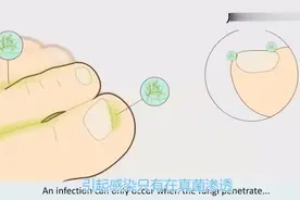 三分钟动画带您了解灰指甲，了解灰指甲的原因及预防视频封面