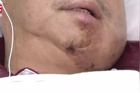 男子口腔颊部出现溃烂确诊为癌症：一天2包槟榔视频封面