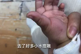 宝宝发烧38.5，手上脚上长水泡，原来是感染上手足口病，好心疼视频封面