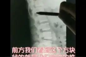腰椎基本X光片分析视频封面