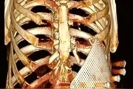 重庆西南医院借3D打印技术成功实施胸部肿瘤切除手术图片