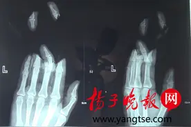女子三只指头被机器咬断 医生10小时紧急手术手指神奇接上图片
