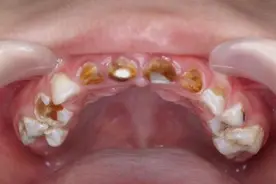 谨慎宝宝牙齿发黑烂牙，家长应科学保养宝宝牙齿健康图片
