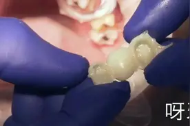 经常听说的烤瓷牙，原来就是这样装在嘴里的视频封面