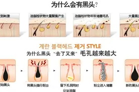 为什么会有黑头？教你去黑头的方法图片
