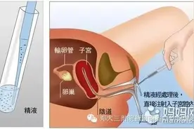 几张图揭开人工授精助孕手术的神秘面纱图片