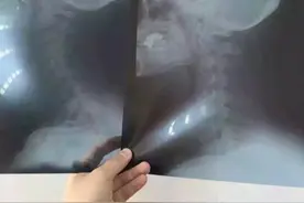 教大家认识下什么是颈椎反弓图片