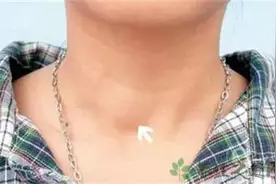 甲状腺结节的发病率怎么这么高？要不要手术？图片