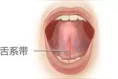 口齿不清，全怪我咯？舌系带：宝宝心里苦！图片