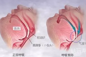 打鼾者福音——云中飞止鼾器图片