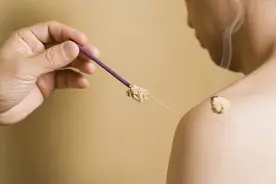 夏治三伏行针忙，伏针疗法能治哪些病？图片
