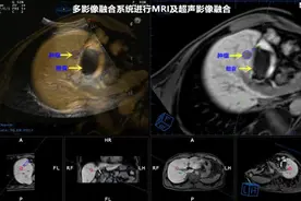 多影像融合超声导航激光消融术挽救肝癌患者图片