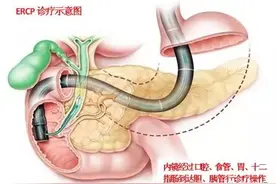 「给力」消化内科成功为复杂胆道情况患者行ERCP治疗图片