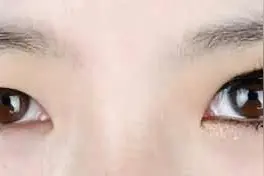 为什么做了双眼皮，眼睛还是不好看！图片