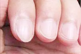 指甲凹凸有棱线是咋回事？可能是身体发出的危险信号！视频封面