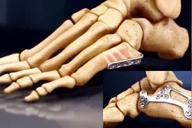 3D动画演示骨折修复过程，看着这满脚的螺丝钉，痛到骨髓里