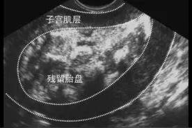 产后三个月，胎盘仍残留，谁之过？图片
