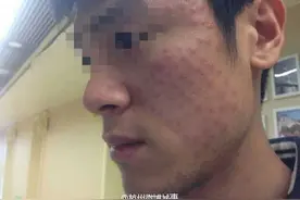 杭州小伙网购水光针自行注射，把脸打成“蜂窝煤”图片