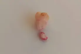 拔智齿时牙根断了，还留了一半在里边，该怎么办？！图片