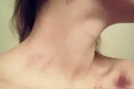“致命”吻痕是如何形成的？图片
