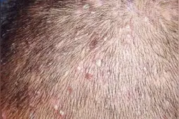 易脱发，多是毛囊炎，简单方法可治疗？视频封面