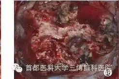 三博分享周忠清：手术切除是根治脑动静脉畸形（BAVM）最有效的方法图片