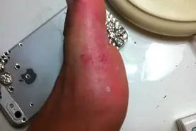 脚气产生的原因 治疗脚气的偏方选择图片
