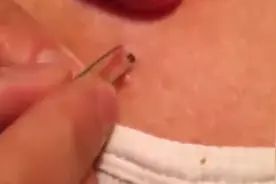 各种大黑头被挤爆的过程，看完莫名的舒畅，有点想挤的冲动！图片